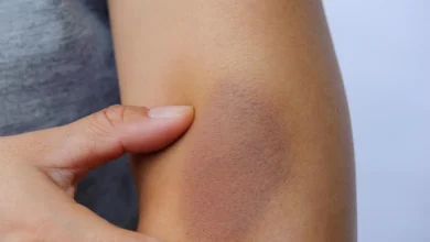 Jednostavna prirodna rešenja za modrice i hematome 3 Jednostavna prirodna rešenja za modrice i hematome