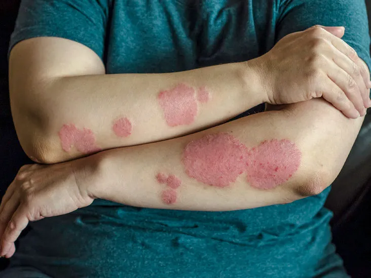 Kako stres utiče na psorijazu - psorijaza