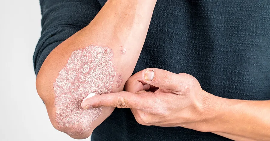 Šta je psorijaza?