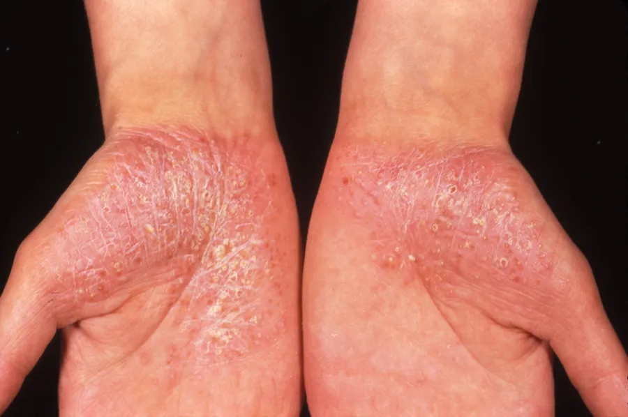 Palmoplantarna psorijaza