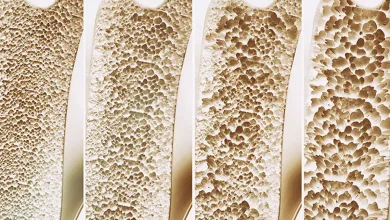 šta je osteoporoza