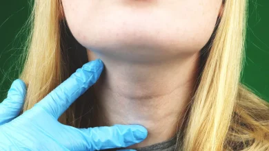 Subakutni tireoiditis (de Quervain)(Thyreoiditis subacuta) 1 Subakutni tireoiditis (de Quervain)(Thyreoiditis subacuta)