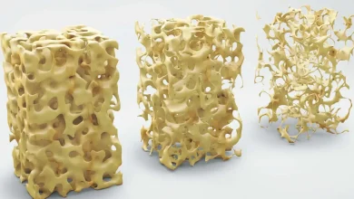 Osteoporoza lečenje