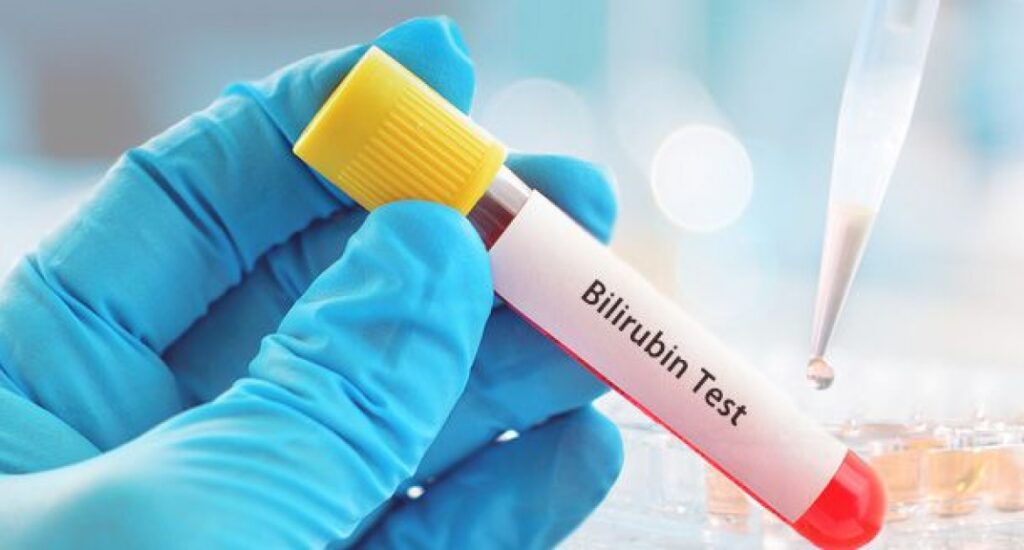 Ukupni bilirubin
