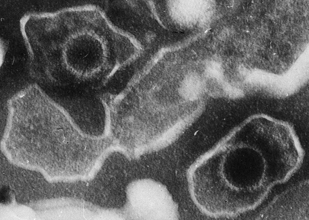 Infektivna mononukleoza-simptomi, prognoza, lečenje