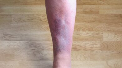 Dr Biljana Petrović: Tromb u nozi – Venska tromboza: Razumevanje uzroka, simptoma i prevencije